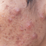 Hoe ontstaat acne?