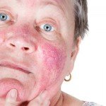 Rosacea: voeding en ingrediënten