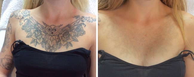 Laserbehandeling tatoeage verwijderen