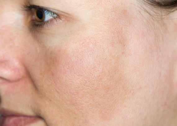 Melasma (zwangerschapsmasker)