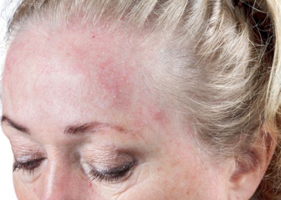 Besnoeiing weggooien Winst Behandeling, advies en producten bij een droge huid | Dermadiq  huidtherapeuten