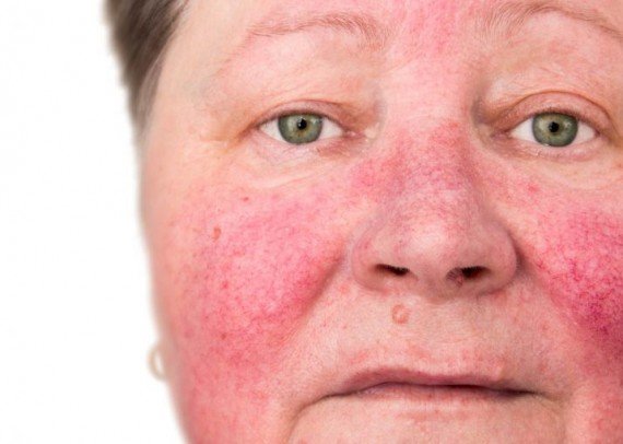 Rosacea