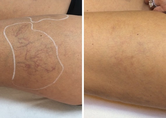 Hertog warm systematisch Laserbehandeling bij blauwe beenvaten | Dermadiq huidtherapeuten